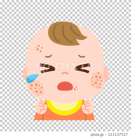 Illustration of a crying baby with a rash on his face 121137527