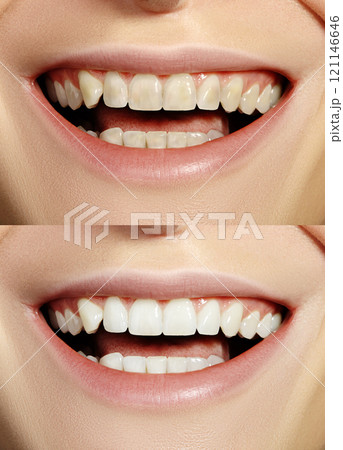 Closeup Macro of Female Teeth Before and After Whitening. Dental Health and Oral Care Concept. Happy Smile with Red Lips Closeup Macro of Female Teeth Before and After Whitening. Dental Health and Oral Care Concept. Happy Smile with Red Lips 121146646