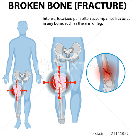 Understanding Bone Fractures and Pain 121155027