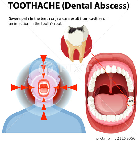 Understanding Dental Abscess and Toothache Understanding Dental Abscess and Toothache 121155056