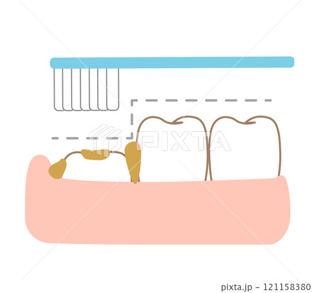 歯ブラシで磨きにくい6才臼歯の段差と歯磨き 121158380