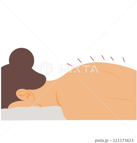 woman with acupuncture needles, Process of acupuncture and needle therapy 121173623