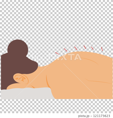 woman with acupuncture needles, Process of acupuncture and needle therapy 121173623