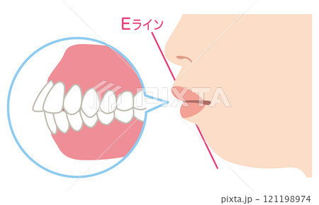 出っ歯な歯並び くちゴボなEライン 歯列矯正 出っ歯な歯並び くちゴボなEライン 歯列矯正 121198974