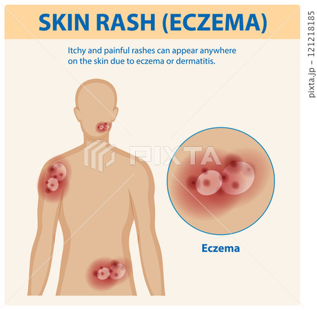 Understanding Eczema and Skin Rashesのイラスト素材 [121218185] - PIXTA