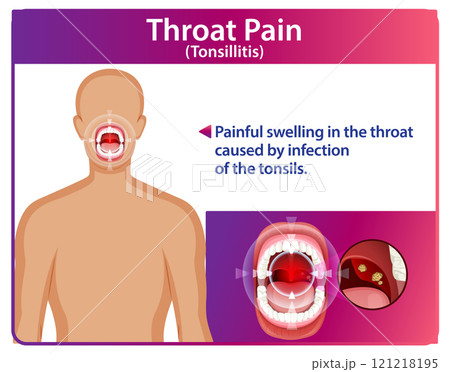 Understanding Throat Pain and Tonsillitis 121218195