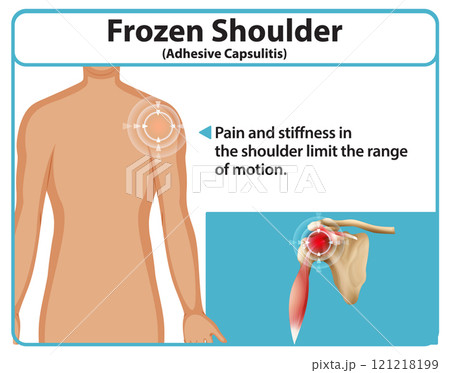 Understanding Frozen Shoulder Condition Understanding Frozen Shoulder Condition 121218199