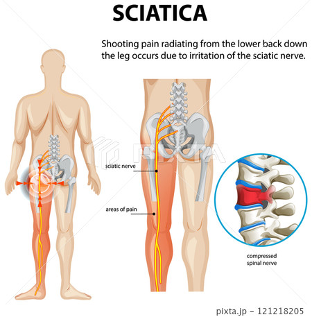 Understanding Sciatica and Nerve Pain 121218205