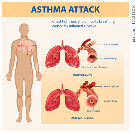 Understanding Asthma and Lung Function Understanding Asthma and Lung Function 121218216