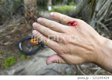 Mountain bike rider hand wounded from hitting a tree stump on forest trail. Biking accident Mountain bike rider hand wounded from hitting a tree stump on forest trail. Biking accident 121245429