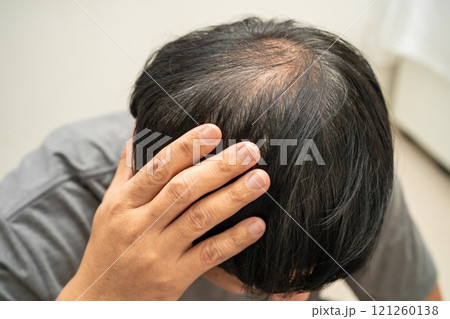 Bald head in man, hair loss treatment health problem. 121260138