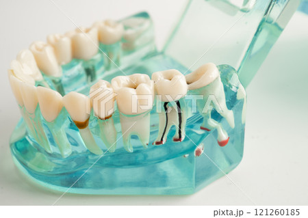 Dental implant, artificial tooth roots into jaw, root canal of dental treatment, gum disease, teeth model for dentist studying about dentistry. 121260185