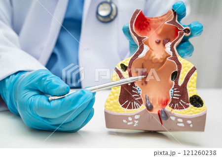 Asian doctor with rectum and hemorrhoid human anatomy model at hospital, inflamed vascular structure. 121260238
