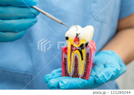 Teeth root dental model with tool for dentist use to cleaning care treatment. Teeth root dental model with tool for dentist use to cleaning care treatment. 121260244