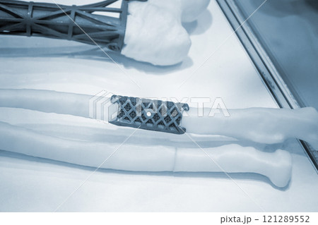 Implants and prostheses printed on 3D printer from biocompatible titanium powder. Titanium implant replacement of tubular bones on white human bone printed on 3D printer. Endoprostheses Bioengineering 121289552