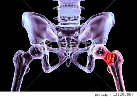 Femur neck fracture, 3D illustration Femur neck fracture, 3D illustration 121290867