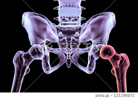 Hip dysplasia, 3D illustration 121290872