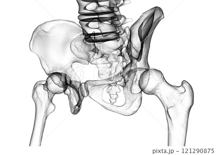 Hip dysplasia, 3D illustration Hip dysplasia, 3D illustration 121290875