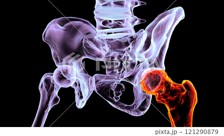Hip osteoarthritis, 3D illustration 121290879