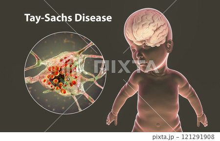 Tay-Sachs disease, 3D illustration 121291908