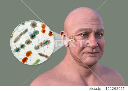 Otitis media in a man, 3D illustration Otitis media in a man, 3D illustration 121292025
