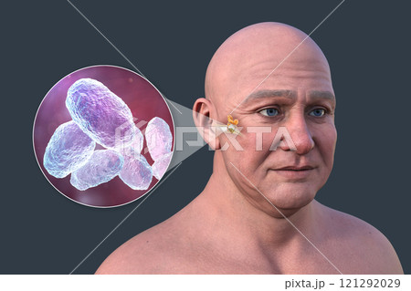 Otitis media in a man, 3D illustration 121292029