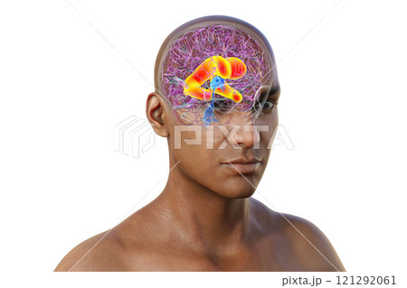 Enlarged lateral ventricles of the brain, 3D illustration 121292061