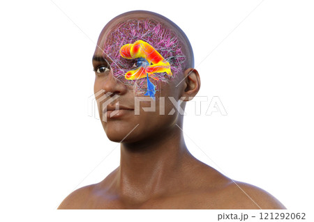 Enlarged lateral ventricles of the brain, 3D illustration 121292062