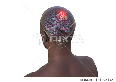Brain tumor, 3D illustration 121292132