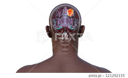 Brain tumor, 3D illustration Brain tumor, 3D illustration 121292135