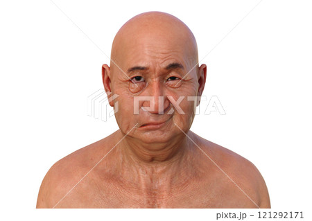 Facial palsy in a man, photorealistic 3D illustration Facial palsy in a man, photorealistic 3D illustration 121292171