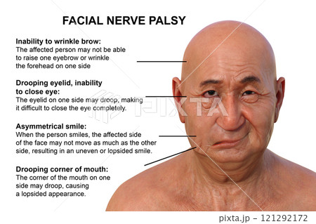 Facial palsy in a man, photorealistic 3D illustration 121292172