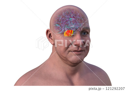 Human brain with the pons highlighted in red, 3D illustration Human brain with the pons highlighted in red, 3D illustration 121292207