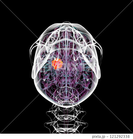 Brain tumor, 3D illustration 121292338
