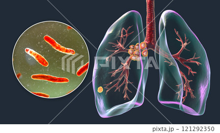 Primary lung tuberculosis with the Ranke complex, 3D illustration Primary lung tuberculosis with the Ranke complex, 3D illustration 121292350
