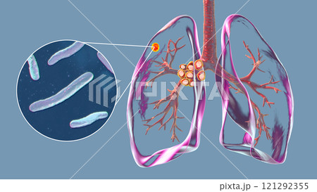Primary lung tuberculosis with the Ranke complex, 3D illustration 121292355