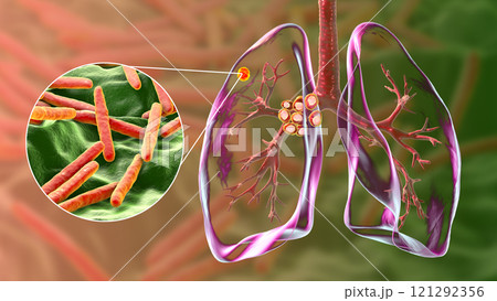 Primary lung tuberculosis with the Ranke complex, 3D illustration 121292356