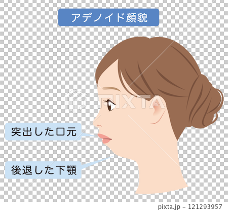 Adenoid facies, displaced lower jaw, E-line, profile 121293957