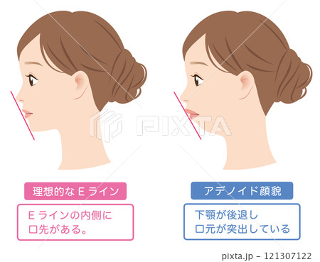 理想的なEラインと、アデノイド顔貌　交代した下顎　横顔 121307122