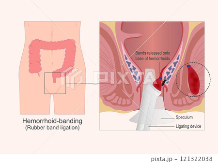 Rubber band ligation also called Hemorrhoid banding. Rubber band ligation also called Hemorrhoid banding. 121322038