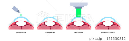 LASIK eye surgery LASIK eye surgery 121330812