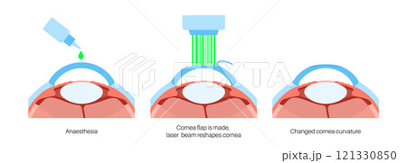 LASIK eye surgery LASIK eye surgery 121330850