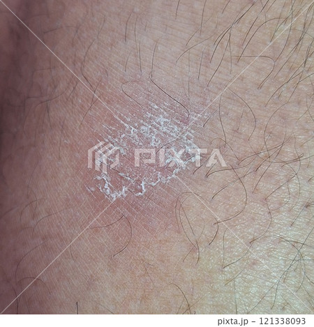Skin diseases. The leg is affected by psoriasis. The skin of the leg is rough and peeling. 121338093
