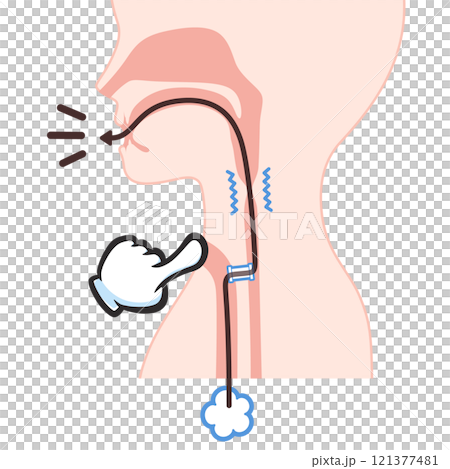 Illustration of shunt phonation after laryngeal cancer surgery Illustration of shunt phonation after laryngeal cancer surgery 121377481
