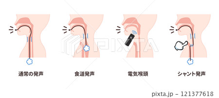 喉頭癌の手術後の発声方法のイラスト_通常の発声_食道発声_電気喉頭_シャント発声 121377618
