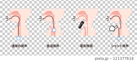 喉頭癌の手術後の発声方法のイラスト_通常の発声_食道発声_電気喉頭_シャント発声 121377618