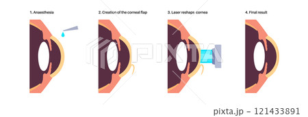 LASIK eye surgery 121433891