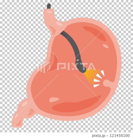 胃カメラ検査を受けてポリープが見つかった胃のイラスト 121438100