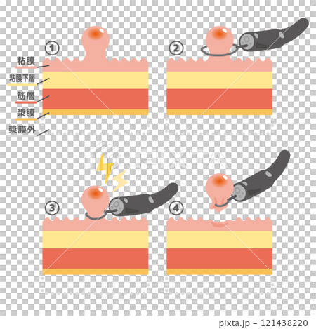 內視鏡治療息肉切除術圖示 121438220