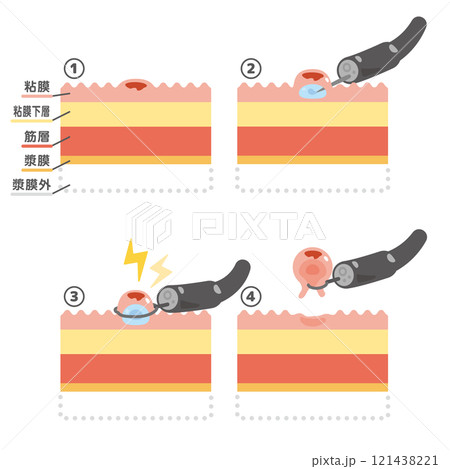 内視鏡治療　EMRのイラスト 121438221